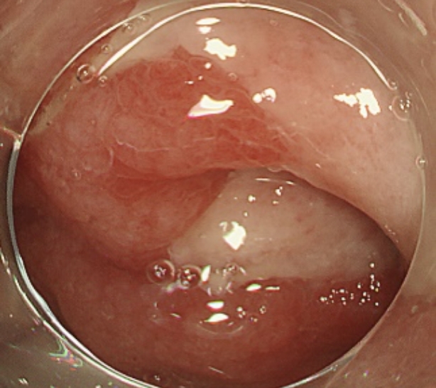 直腸潰瘍